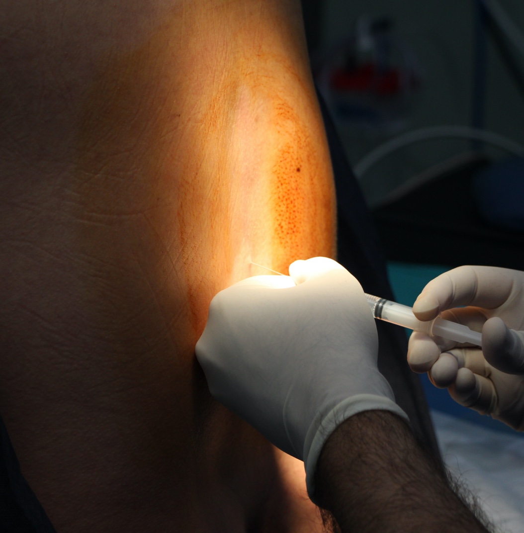 image of an epidural being inserted